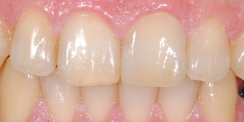 Faccetta estetica anteriore in ceramica-5