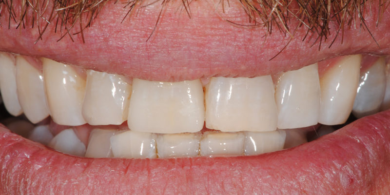 Faccetta estetica anteriore in ceramica2-5