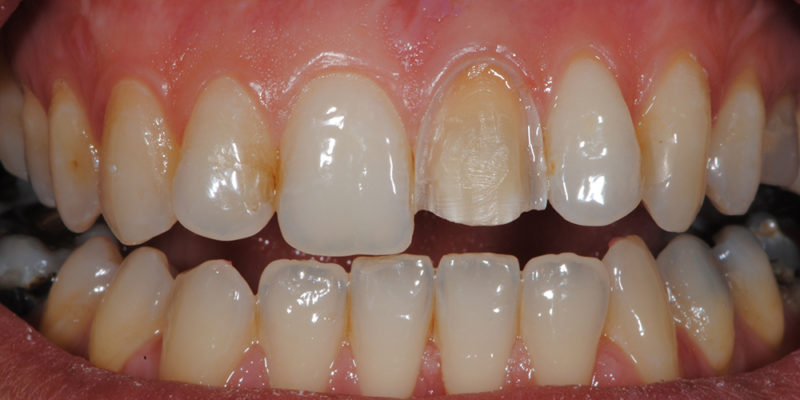 Faccetta estetica anteriore in ceramica3-3