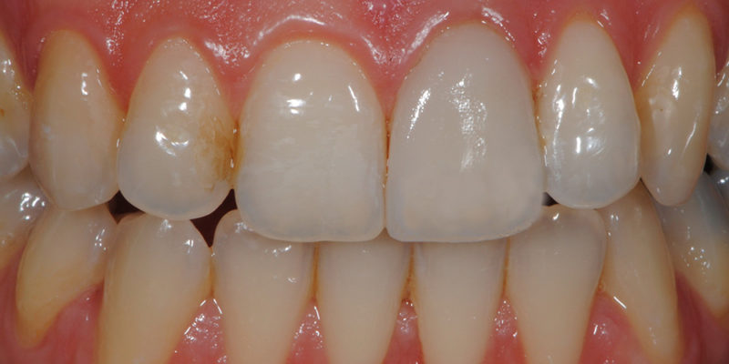 Faccetta estetica anteriore in ceramica3-7