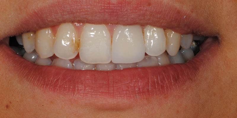 Faccetta estetica anteriore in ceramica3-8