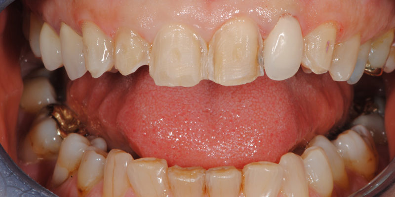 Faccette estetiche anteriori in ceramica-4