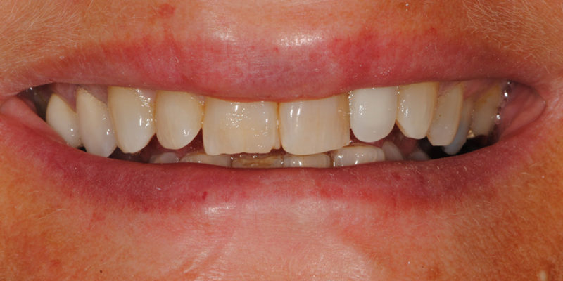 Faccette estetiche anteriori in ceramica