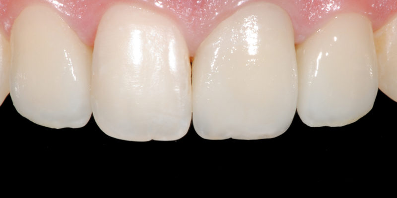 Faccette estetiche anteriori in ceramica2-6