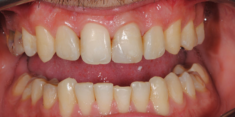 Faccette estetiche anteriori in ceramica2