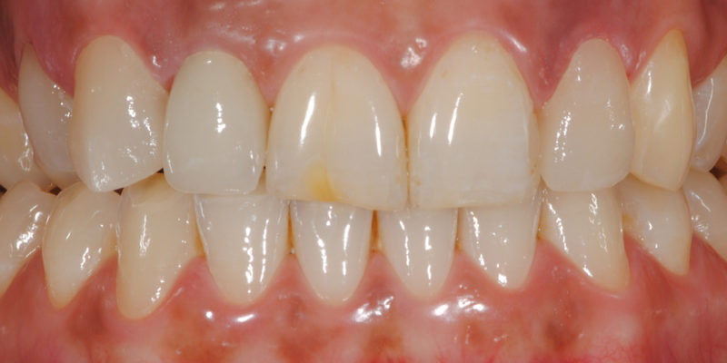 Faccette estetiche anteriori in ceramica3-4