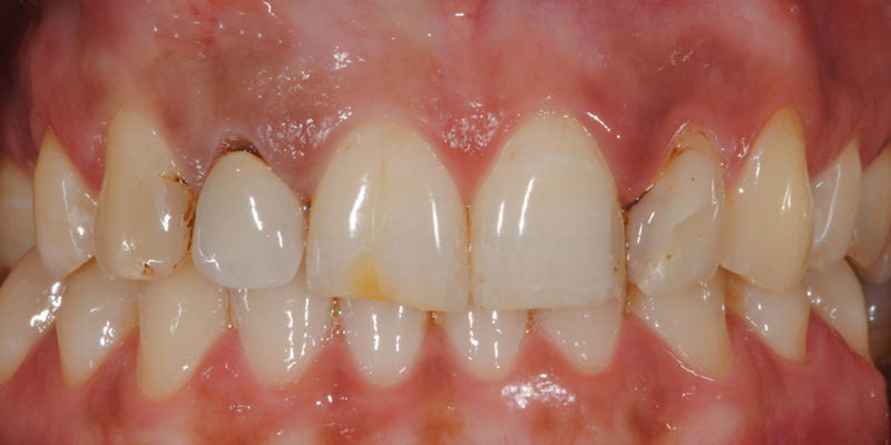 Faccette estetiche anteriori in ceramica3