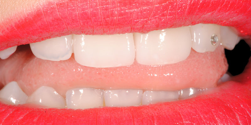 Ricostruzione di vecchie cure in composito su denti fratturati-7