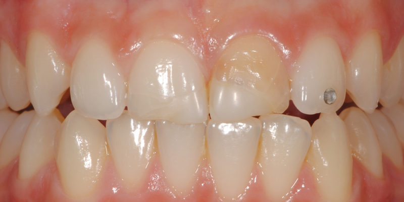 Ricostruzione di vecchie cure in composito su denti fratturati