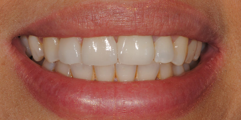 Ricostruzione estetica anteriore con faccetta e corona in ceramica-5