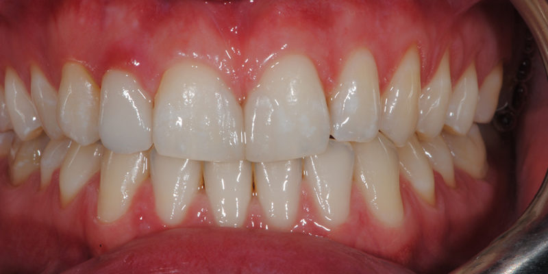 Ricostruzioni estetiche anteriori non invasive-5
