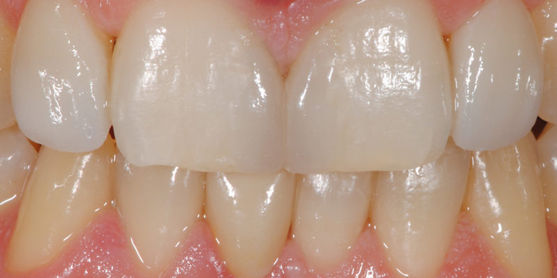 Ricostruzioni estetiche non invasive e faccette-7