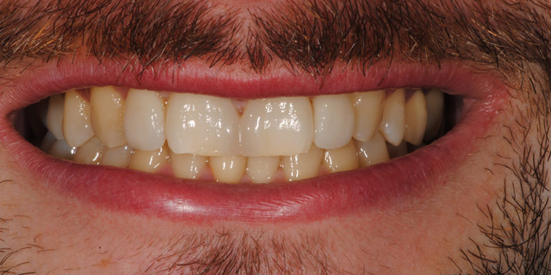 Ricostruzioni estetiche non invasive e faccette-8