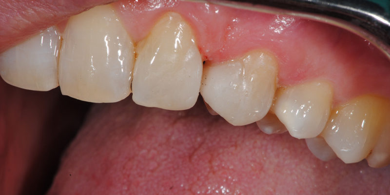 Ricostruzioni estetiche non invasive pt.2-3