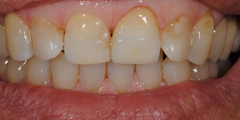 Sostituzione di cura in composito su incisivo con faccetta-6