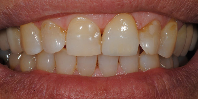 Sostituzione di cura in composito su incisivo con faccetta-7