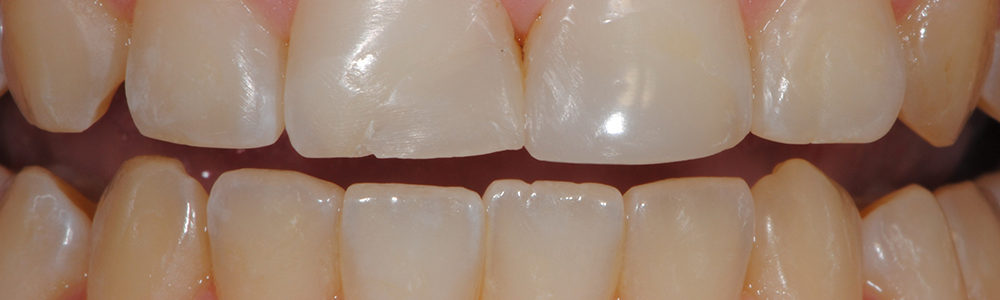 Sostituzione di vecchie cure in composito