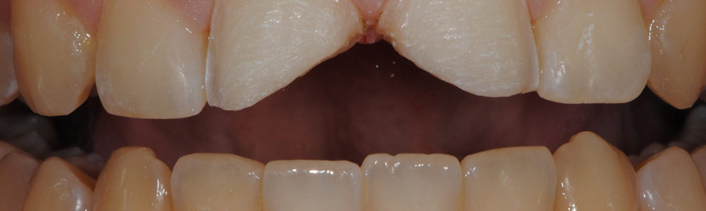 Sostituzione di vecchie cure in composito-2