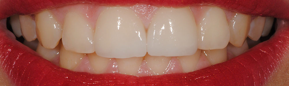 Sostituzione di vecchie cure in composito-6