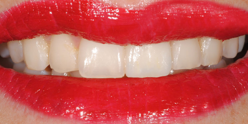 Sostituzione di vecchie cure in composito con faccette-5