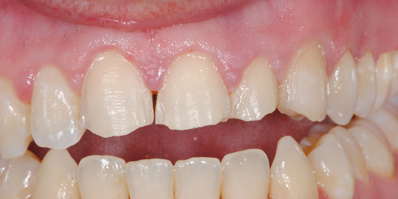 Sostituzione di vecchie cure in composito con faccette2-5