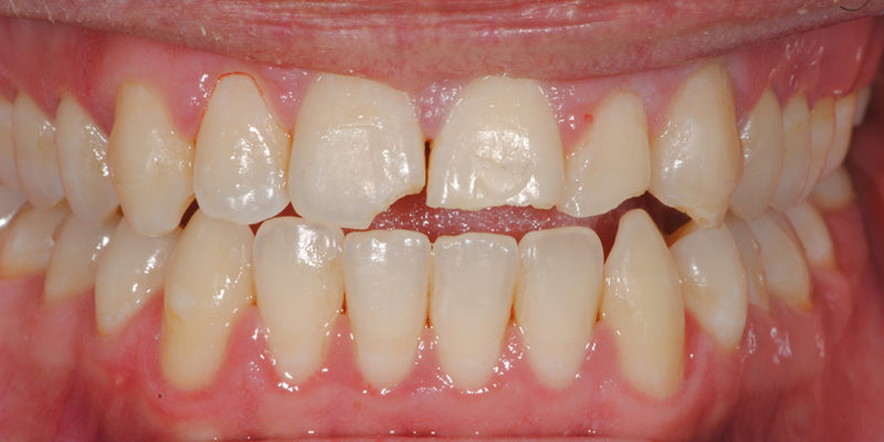 Sostituzione di vecchie cure in composito con faccette2