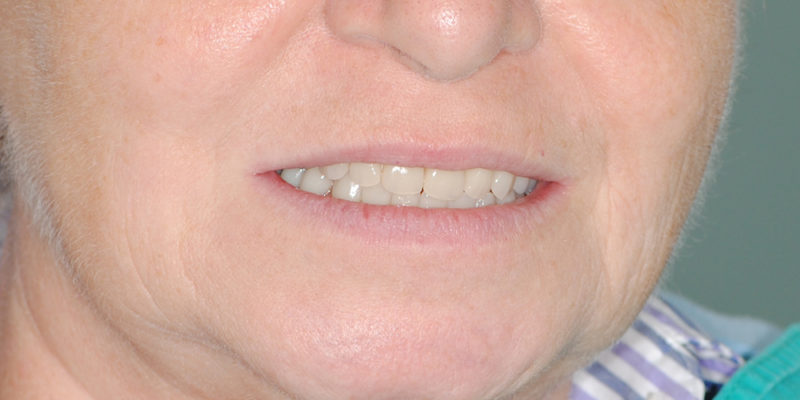 Protesi mobile superiore + overdenture inferiore-10