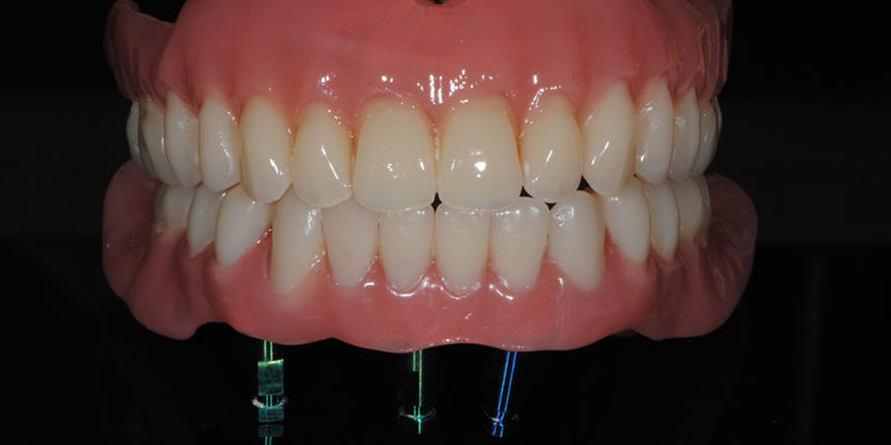 Protesi mobile superiore + overdenture inferiore-6
