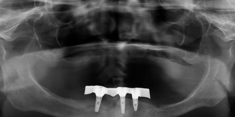 Protesi mobile superiore + overdenture inferiore