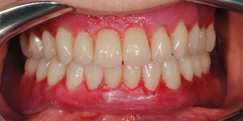 Protesi mobile superiore + overdenture inferiore-9