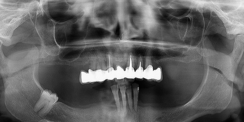 Ripristino dell'arcata inferiore