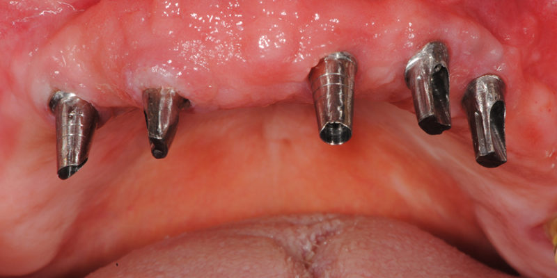 Ripristino dell'arcata superiore atrofica