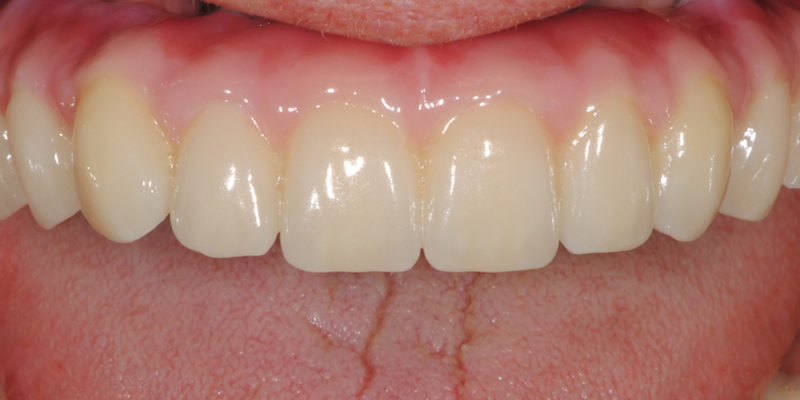 Ripristino dell'arcata superiore atrofica pt.2-3