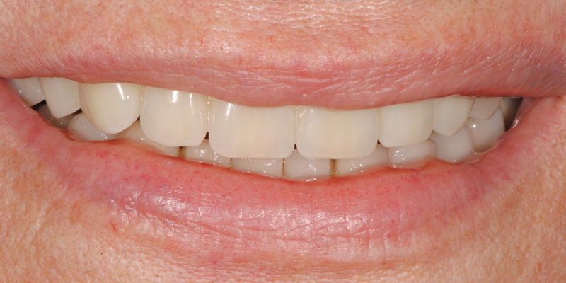 Ripristino dell'arcata superiore atrofica pt.2-4