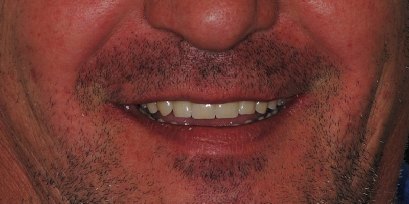 Ripristino dell'arcata superiore ed inferiore-11