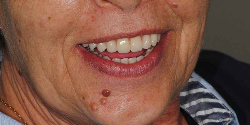 Ripristino dell'arcata superiore ed inferiore su overdenture su barra-11