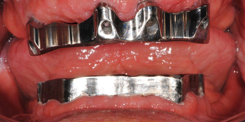 Ripristino dell'arcata superiore ed inferiore su overdenture su barra-5