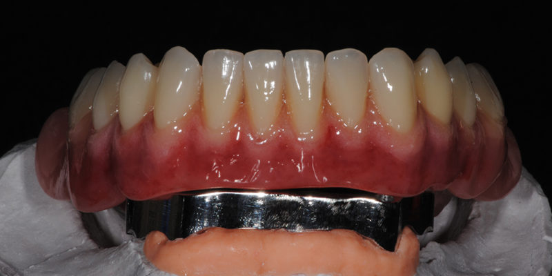Ripristino dell'arcata superiore ed inferiore su overdenture su barra-8