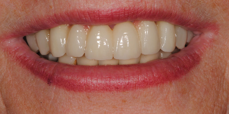 Ripristino dell'arcata superiore su impianti-7