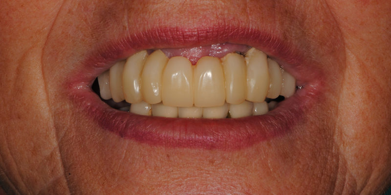 Ripristino dell'arcata superiore su impianti