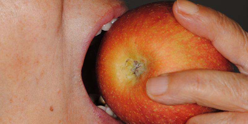 Ripristino dell'arcata superiore su overdenture su barra-10