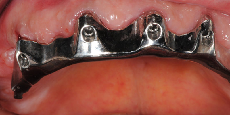 Ripristino dell'arcata superiore su overdenture su barra-7