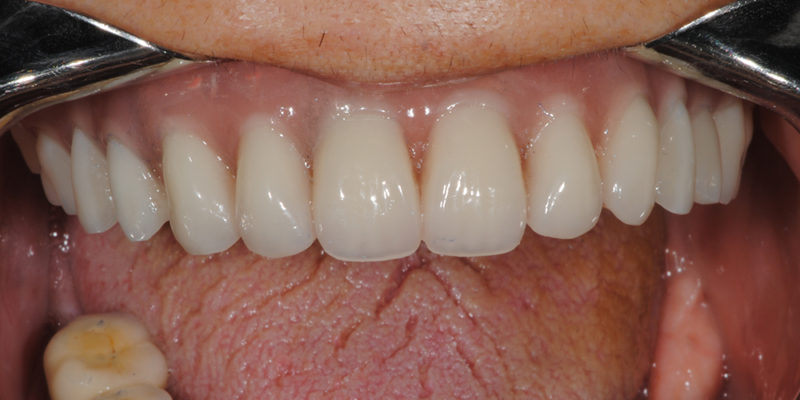 Ripristino dell'arcata superiore su overdenture su barra-8