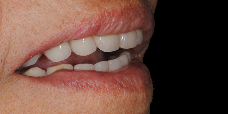 Ripristino dell'arcata superiore su overdenture su barra-9